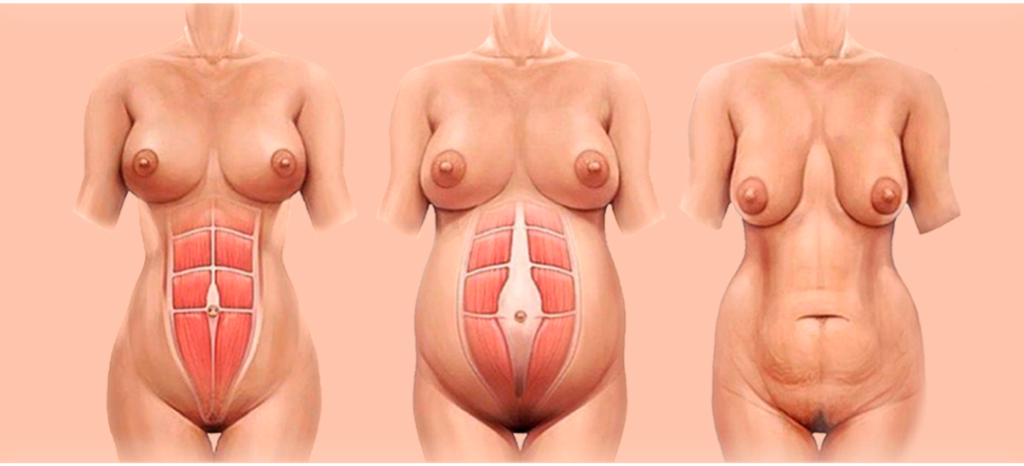 resultados mommy makeover cirurgia da mamãe lipoabdominoplastia com mamoplastia