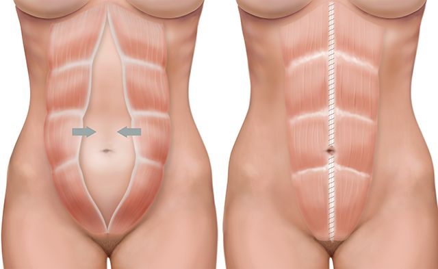 lipoabdominoplastia antes e depois diástase abdominal Dr Gilberto Pereira