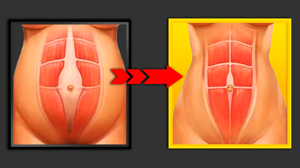 Resultado abdominoplastia pÃ³s-gravidez antes e depois Dr Gilberto Pereira